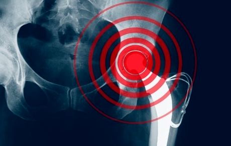 ۳ توصیه کلیدی درباره پوکی استخوان
