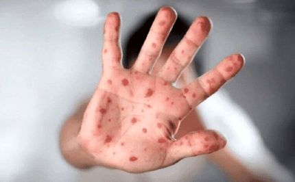 اولین فوتی آبله میمونی در آسیا ثبت شد