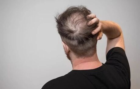 این نوشیدنی‌ها، ریزش مو را بیشتر می‌کند