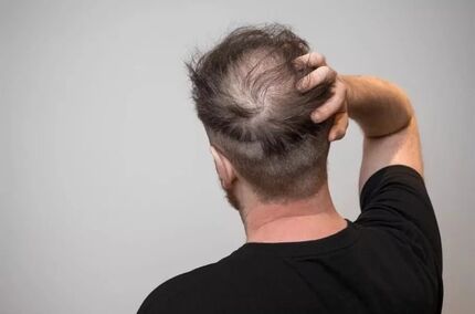 این نوشیدنی‌ها، ریزش مو را بیشتر می‌کند