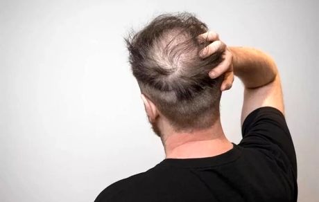 این نوشیدنی‌ها، ریزش مو را بیشتر می‌کند