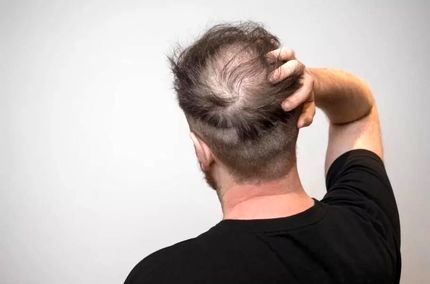 این نوشیدنی‌ها، ریزش مو را بیشتر می‌کند