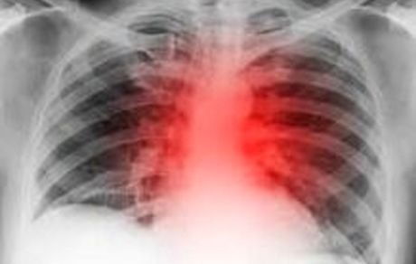 کاهش خطر بیماری قلبی با زندگی در مناطق سرسبز