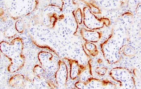 آسیب به جفت عامل مرده‌زایی در زنان باردار مبتلا به کووید-۱۹