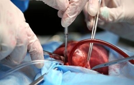 غربالگری اشتباه برای پیوند عضو در آمریکا، ۷۰ کشته در پی داشت