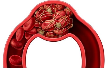 داروی جدیدی برای کاهش آسیب‌های ناشی از سکته