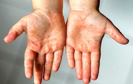 ابتلا به بیماری سرخک در جهان ۸۰ درصد افزایش یافت