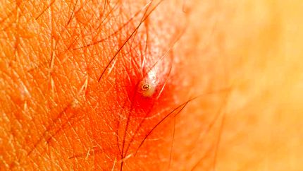 درمان خانگی زگیل تناسلی مردان با طب سنتی جدید