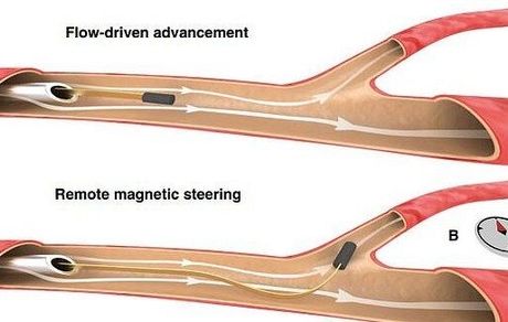 ساخت سیمی باریکتر از مو برای حرکت در مویرگ‌های مغز