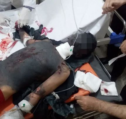 یک نوجوان روانسری در حوادث چهارشنبه آخر سال، دو دستش را از دست داد