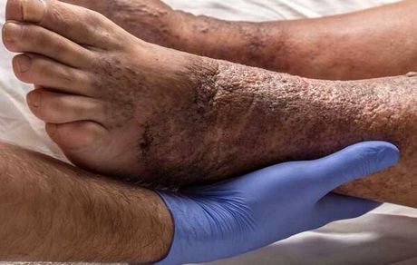 احتمال دچار شدن ۱۵ درصد بیماران دیابتی به زخم‌های این بیماری