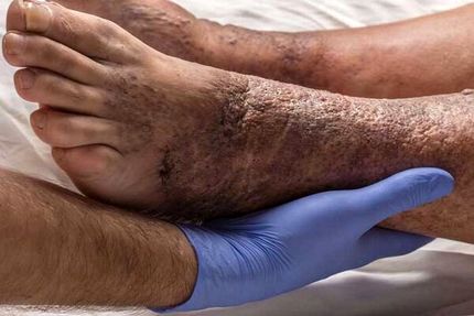 احتمال دچار شدن ۱۵ درصد بیماران دیابتی به زخم‌های این بیماری