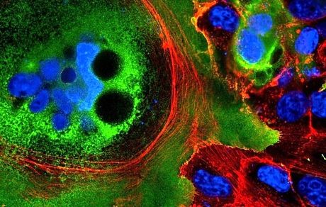 تاثیر داروی ضدانگل برای جلوگیری از عفونت ریوی کووید-۱۹