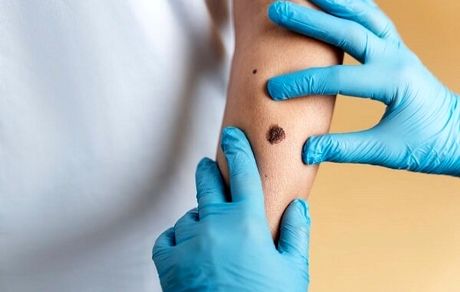 نتایج اولیه آزمایش داروی درمان سرطان پوست منتشر شد