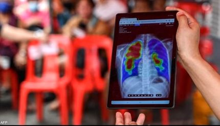 جان باختن یک میلیون نفر در جهان بر اثر ابتلا به بیماری سل در سال گذشته