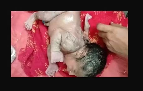 به دنیا آمدن نوزادی با ۳ دست همه را به تعجب واداشت
