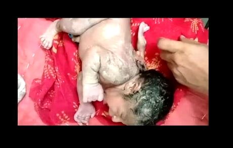 به دنیا آمدن نوزادی با ۳ دست همه را به تعجب واداشت
