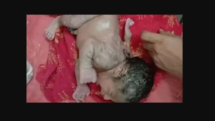 به دنیا آمدن نوزادی با ۳ دست همه را به تعجب واداشت