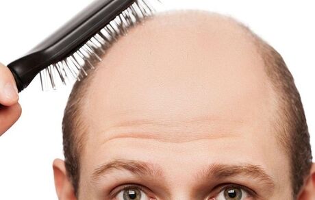 طب سنتی چه راهکارهایی برای جلوگیری از ریزش مو دارد؟