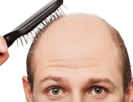 طب سنتی چه راهکارهایی برای جلوگیری از ریزش مو دارد؟