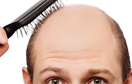 طب سنتی چه راهکارهایی برای جلوگیری از ریزش مو دارد؟