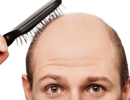 طب سنتی چه راهکارهایی برای جلوگیری از ریزش مو دارد؟