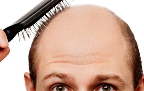 طب سنتی چه راهکارهایی برای جلوگیری از ریزش مو دارد؟