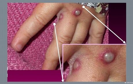 آبله میمونی گسترش یافت / سازمان جهانی بهداشت خواستار اقدام فوری شد