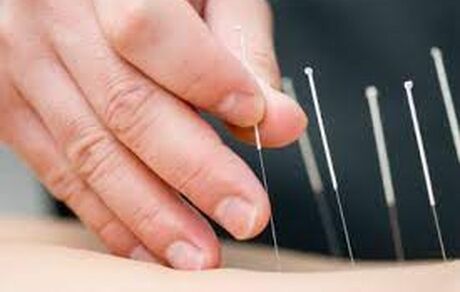 طب سوزنی و یائسگی