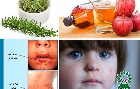 گیاهان دارویی موثر در درمان بیماری زرد زخم