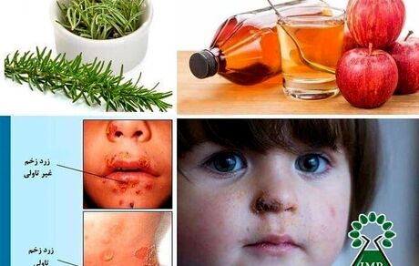 گیاهان دارویی موثر در درمان بیماری زرد زخم