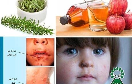 گیاهان دارویی موثر در درمان بیماری زرد زخم