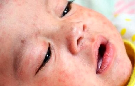 آخرین وضعیت «سرخک» در ایران / تدارک واکسیناسیون سریع‌تر اتباع خارجی