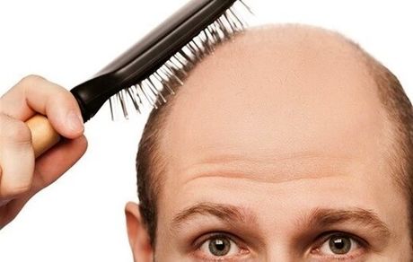 ادعای جدید محققان: احتمال ابتلا به کرونا در افراد طاس بیشتر است