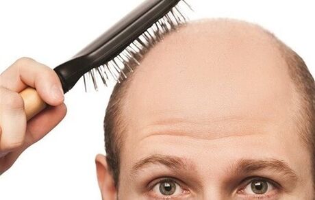 ادعای جدید محققان: احتمال ابتلا به کرونا در افراد طاس بیشتر است