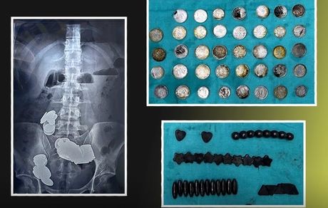 وزنه‌بردار هندی در تمرینات بدنسازی ۳۹ سکه و ۳۷ آهن‌ربا خورد