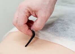 جایگاه درمانی زالو در طب سنتی