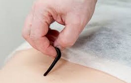 جایگاه درمانی زالو در طب سنتی