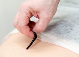 جایگاه درمانی زالو در طب سنتی