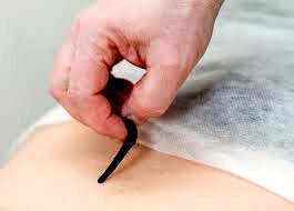 جایگاه درمانی زالو در طب سنتی