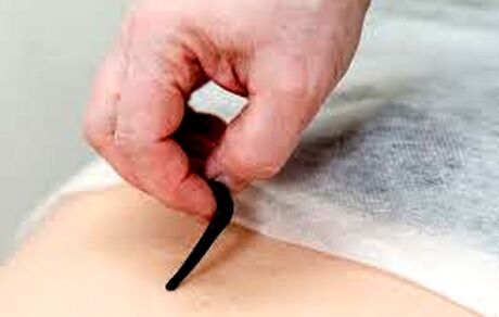 جایگاه درمانی زالو در طب سنتی