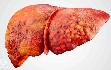  دلایل اصلی‌ بیماری کبد چرب چیست؟ 