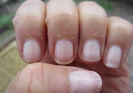 راهکار طب سنتی برای درمان عفونت کنار ناخن