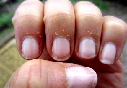راهکار طب سنتی برای درمان عفونت کنار ناخن