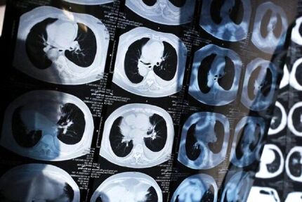 روشی جدید برای تشخیص سرطان ریه در مراحل اولیه