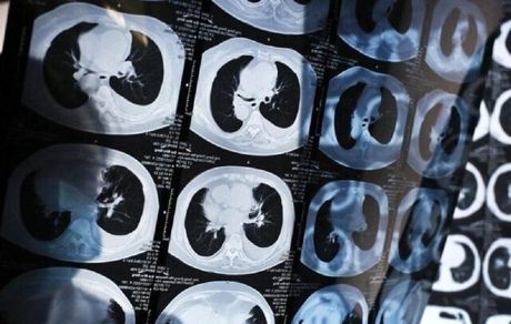 روشی جدید برای تشخیص سرطان ریه در مراحل اولیه