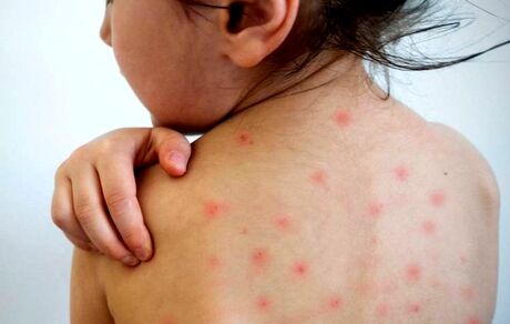 شیوع سرخک در کشور / بیشترین ابتلا در سیستان و بلوچستان