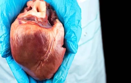 موفقیت آمیز بودن اولین عمل پیوند قلب دو بیماری HIV مثبت