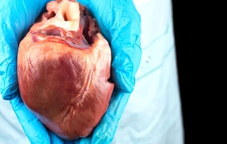 موفقیت آمیز بودن اولین عمل پیوند قلب دو بیماری HIV مثبت