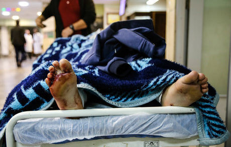 بیماران سوخته «تریبون» ندارند/ سالی ۳۰ هزار نفر دچار سوختگی جدی می‌شوند